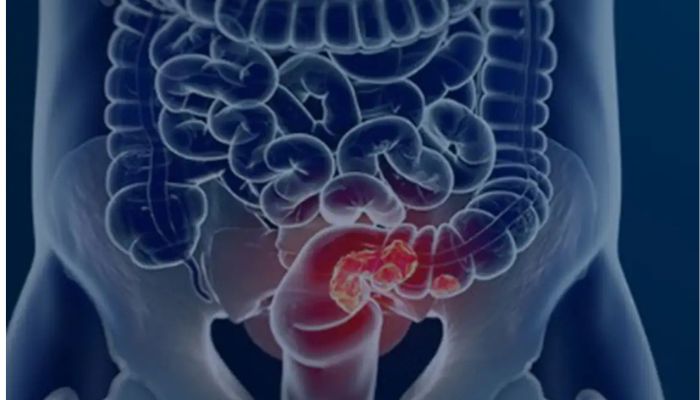 Pacientes com câncer colorretal são diagnosticados em estágio avançado